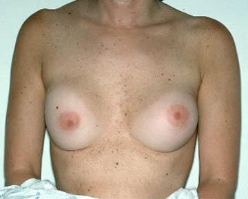 Breast Implant Correction Before & After Image