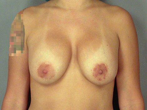 Breast Implant Correction Before & After Image