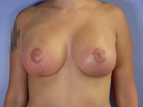 Breast Implant Correction Before & After Image