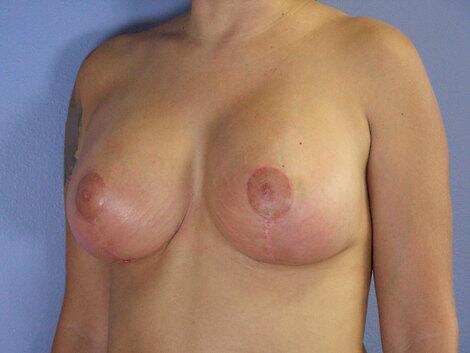 Breast Implant Correction Before & After Image