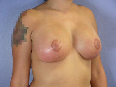 Breast Implant Correction Before & After Image