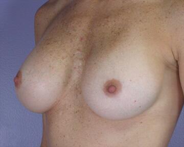 Breast Implant Correction Before & After Image