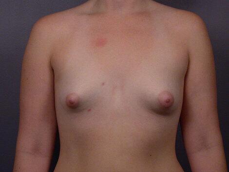 Breast Implant Correction Before & After Image