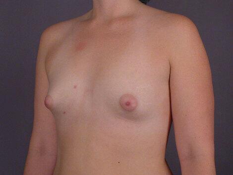 Breast Implant Correction Before & After Image