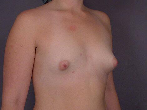 Breast Implant Correction Before & After Image