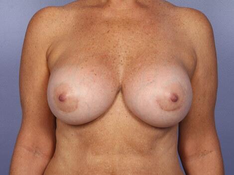 Breast Implant Correction Before & After Image