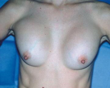 Breast Implant Correction Before & After Image