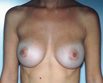 Breast Implant Correction Before & After Image