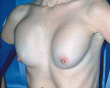 Breast Implant Correction Before & After Image