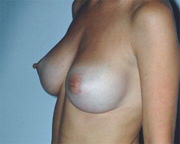 Breast Implant Correction Before & After Image