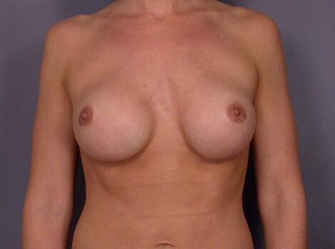 Breast Implant Correction Before & After Image