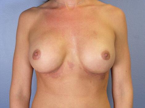 Breast Implant Correction Before & After Image