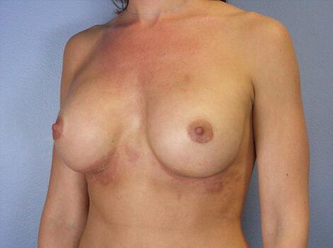 Breast Implant Correction Before & After Image