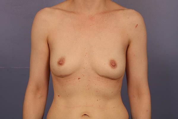 Breast Implant Removal Before & After Image