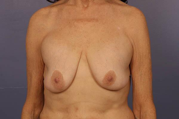 Breast Implant Removal Before & After Image