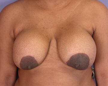 Breast Implant Removal Before & After Image