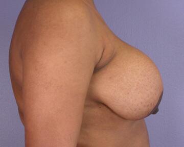 Breast Implant Removal Before & After Image