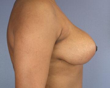 Breast Implant Removal Before & After Image