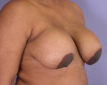 Breast Implant Removal Before & After Image