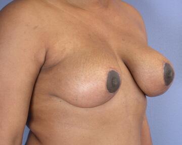 Breast Implant Removal Before & After Image