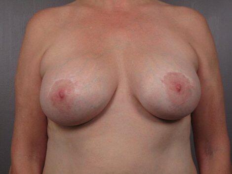 Breast Implant Removal Before & After Image