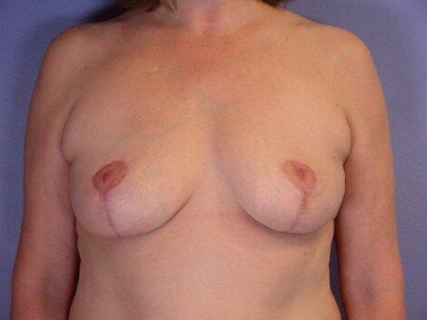 Breast Implant Removal Before & After Image