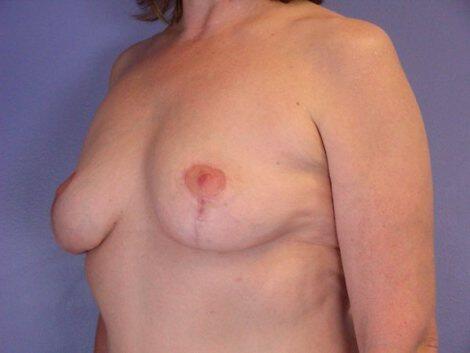 Breast Implant Removal Before & After Image