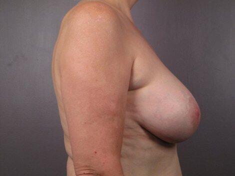 Breast Implant Removal Before & After Image