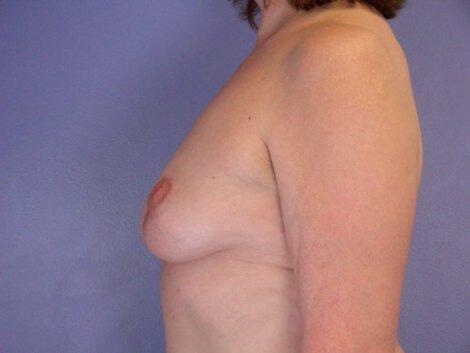 Breast Implant Removal Before & After Image