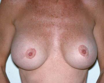 Breast Implant Removal Before & After Image