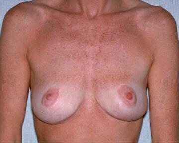 Breast Implant Removal Before & After Image