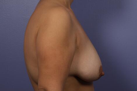 Breast Lift with Augmentation Before & After Image