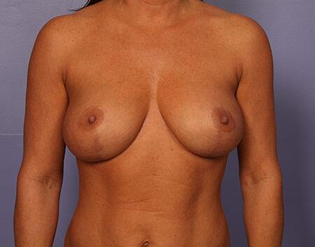 Breast Lift with Augmentation Before & After Image