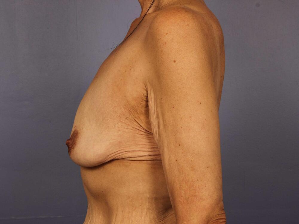 Breast Lift with Augmentation Before & After Image