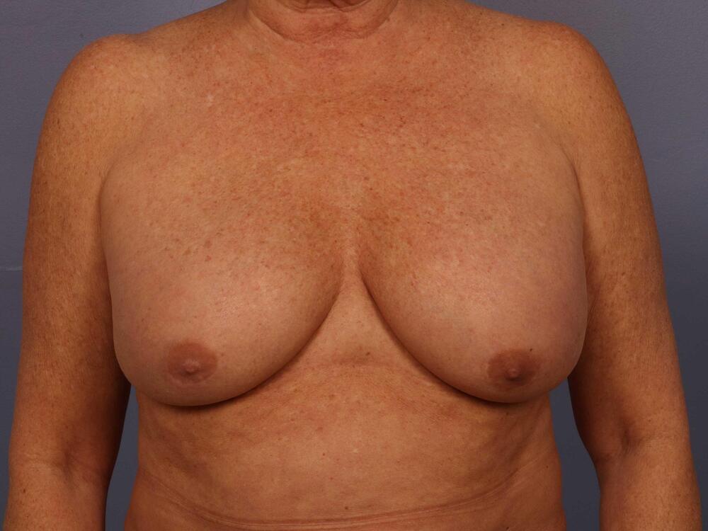 Breast Lift with Augmentation Before & After Image