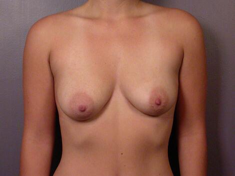 Breast Lift with Augmentation Before & After Image