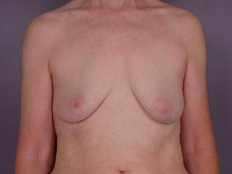 Breast Lift with Augmentation Before & After Image