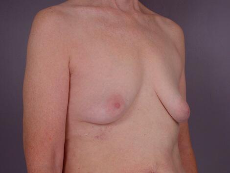 Breast Lift with Augmentation Before & After Image