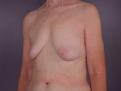 Breast Lift with Augmentation Before & After Image