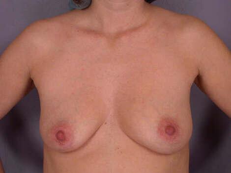 Breast Lift with Augmentation Before & After Image