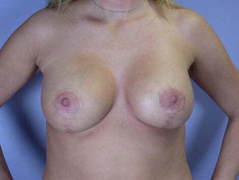 Breast Lift with Augmentation Before & After Image