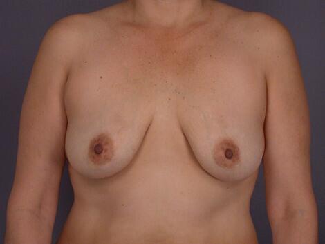 Breast Lift with Augmentation Before & After Image