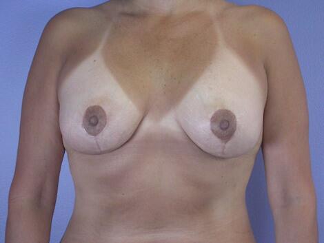 Breast Lift with Augmentation Before & After Image