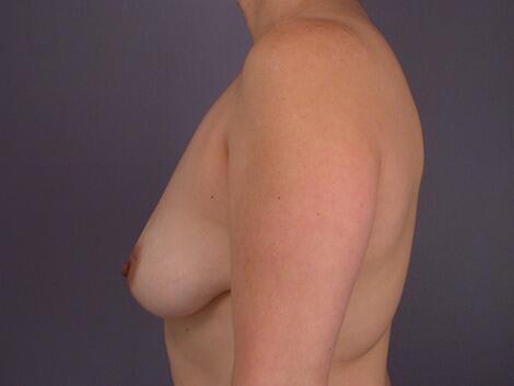 Breast Lift with Augmentation Before & After Image