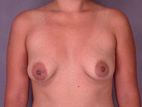 Breast Lift with Augmentation Before & After Image