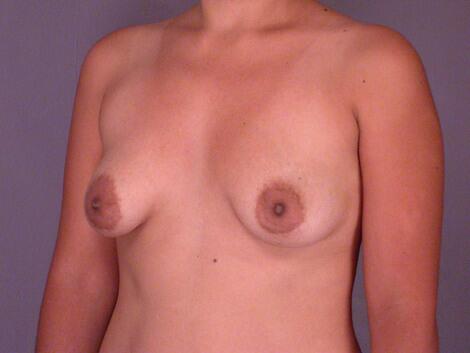 Breast Lift with Augmentation Before & After Image