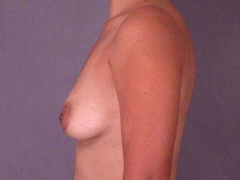 Breast Lift with Augmentation Before & After Image