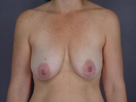 Breast Lift with Augmentation Before & After Image