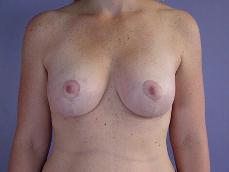Breast Lift with Augmentation Before & After Image