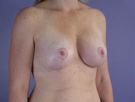 Breast Lift with Augmentation Before & After Image